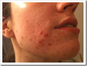 Face with acne
