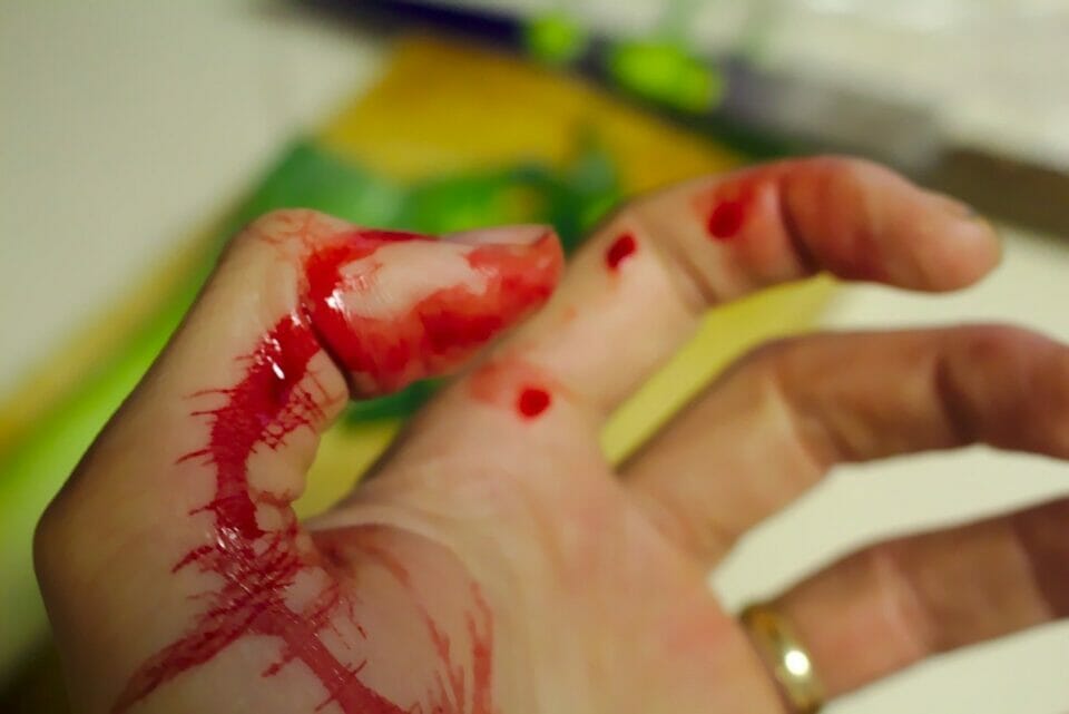 Bleeding hand